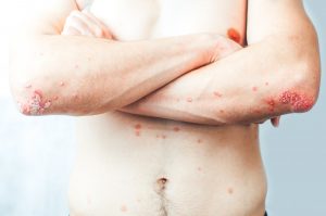 Dermatologie Hauterkrankung Schuppenflechte