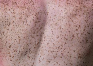 Klassische Dermatologie: Hautkrebsvorsorge, Hautkrebs-Therapie, Muttermale, Allergien